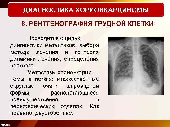 Легкие диагнозы. Хорионкарцинома диагностика. Метастазирование хорионкарциномы.. Хорионкарцинома клинический диагноз.