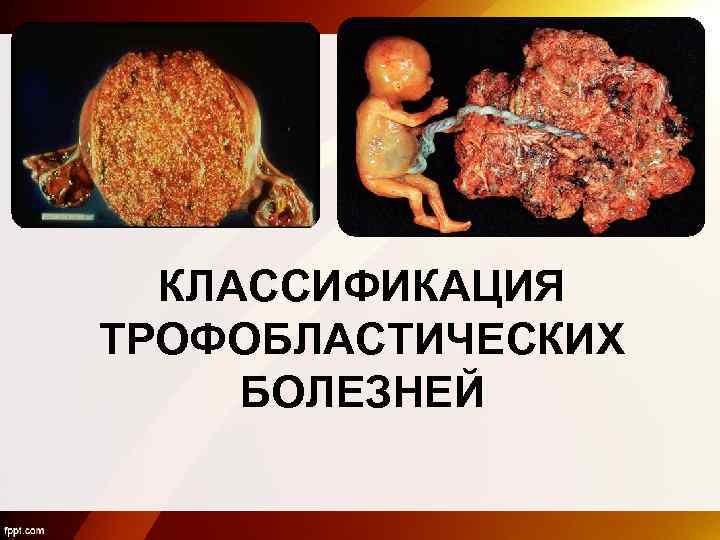 КЛАССИФИКАЦИЯ ТРОФОБЛАСТИЧЕСКИХ БОЛЕЗНЕЙ 