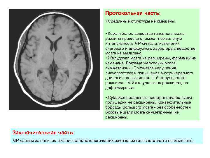 Протокольная часть: • Срединные структуры не смещены. • Кора и белое вещество головного мозга