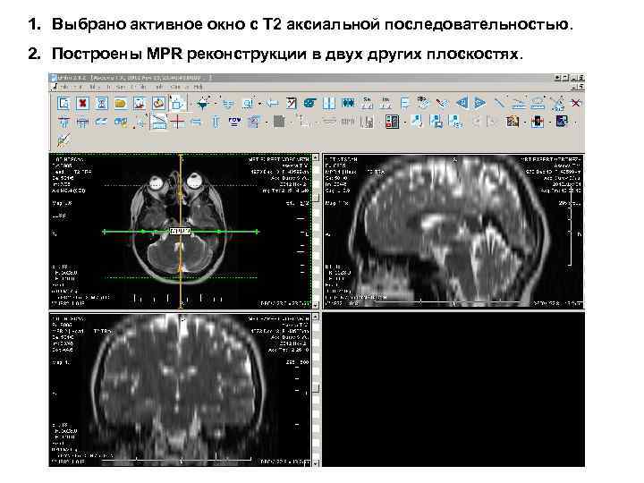 1. Выбрано активное окно с Т 2 аксиальной последовательностью. 2. Построены MPR реконструкции в