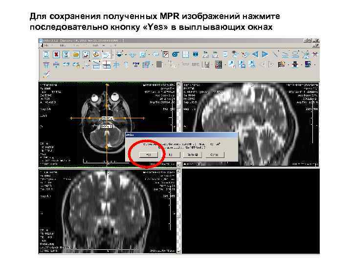 Для сохранения полученных MPR изображений нажмите последовательно кнопку «Yes» в выплывающих окнах 