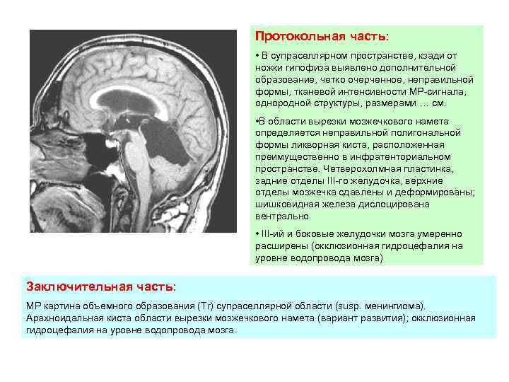 Супраселлярная цистерна пролабирует в полость