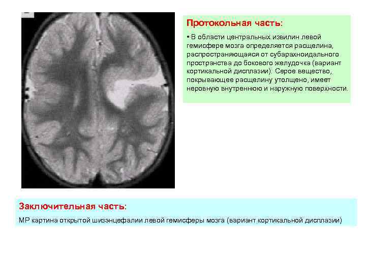 Фото извилины мозга