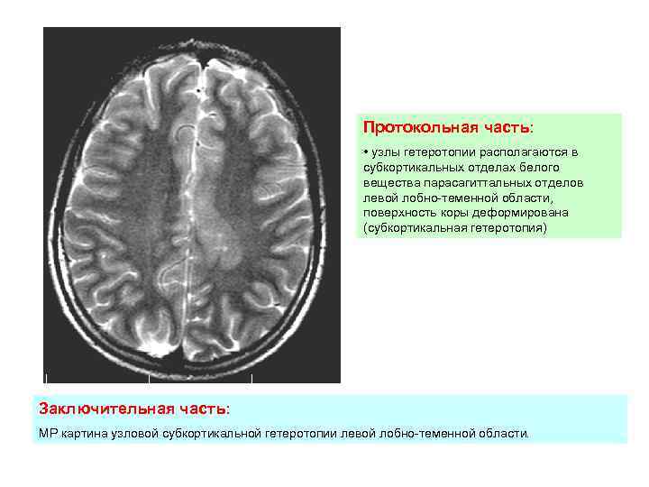 Мр картина латеровентрикулоасимметрии
