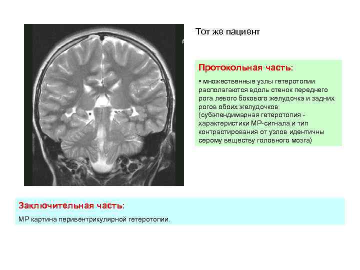 Тот же пациент Протокольная часть: • множественные узлы гетеротопии располагаются вдоль стенок переднего рога