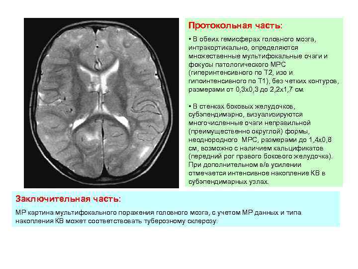 Образование правой гемисферы