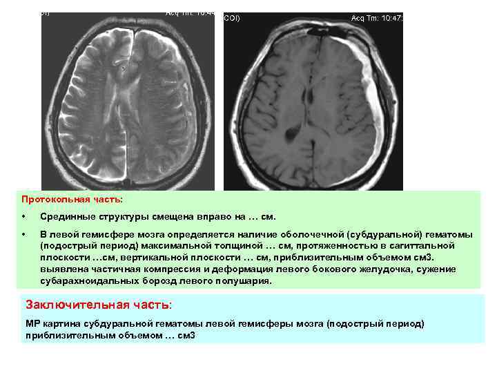 Гемисфер единичное. Подострая субдуральная гематома на кт. Срединные структуры смещены вправо. Смещение срединных структур. Гипоплазия гемисферы мозжечка.