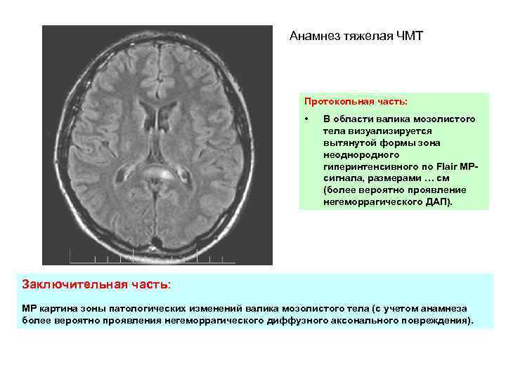 Анамнез тяжелая ЧМТ Протокольная часть: • В области валика мозолистого тела визуализируется вытянутой формы