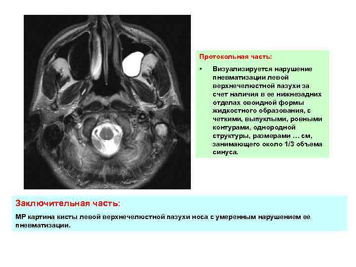 Протокольная часть: • Визуализируется нарушение пневматизации левой верхнечелюстной пазухи за счет наличия в ее