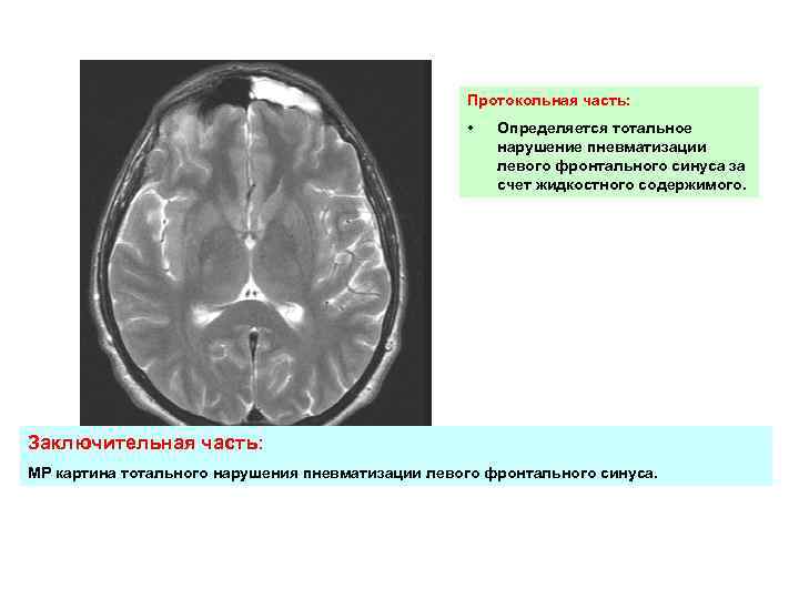 Протокольная часть: • Определяется тотальное нарушение пневматизации левого фронтального синуса за счет жидкостного содержимого.