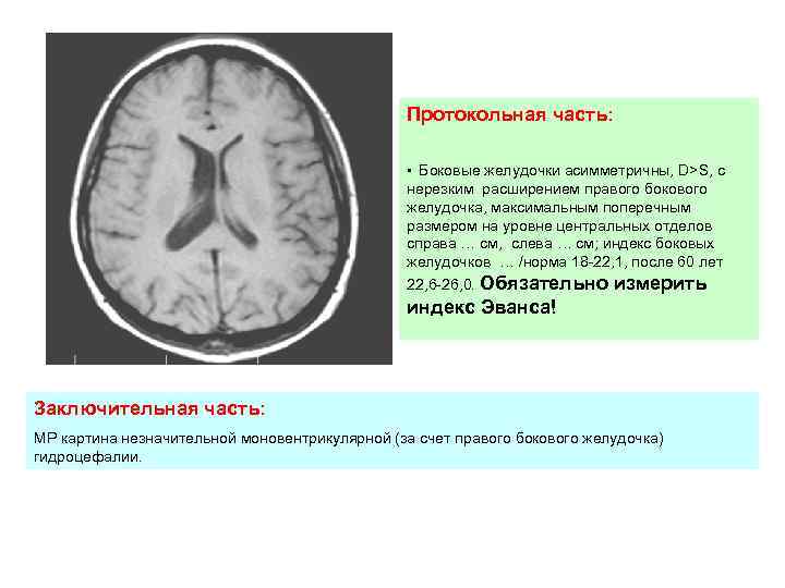 Мр картина латеровентрикулоасимметрии d s