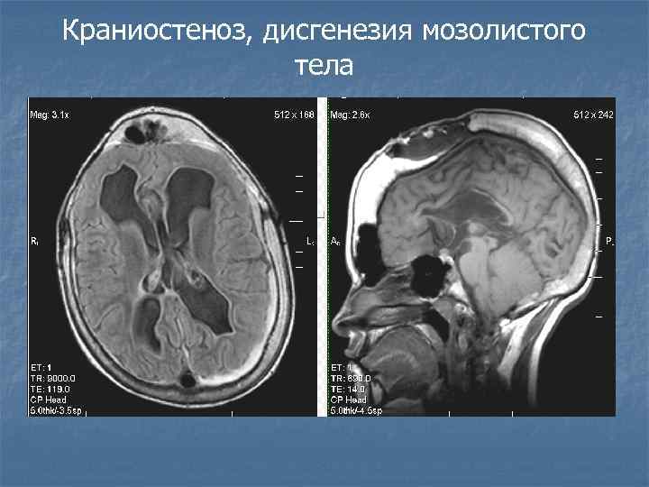 Краниостеноз, дисгенезия мозолистого тела 