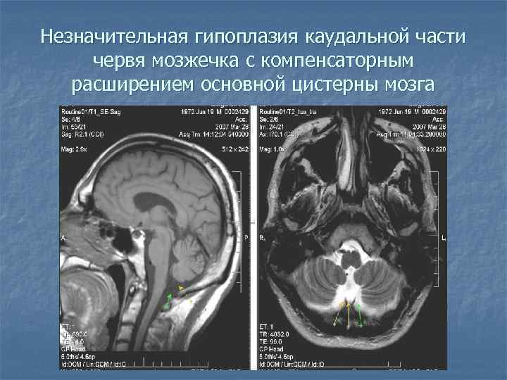 Гипоплазия правой головного мозга. Ретроцеребеллярная цистерна киста. ВПР ЦНС гипоплазия червя мозжечка. Цистерны мозжечка кт. Гипоплазия червя мозжечка кт.