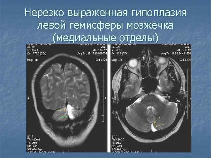 Гипоплазия левого поперечного синуса головного мозга. Ретроцеребральная киста мрт. Гипоплазия червя мозжечка кт. Гипоплазия гемисферы мозжечка кт. Поражение мозжечка мрт.