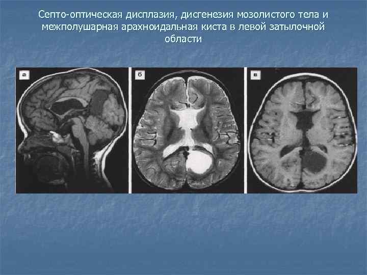 Гипоплазия правой головного мозга. Дисплазия мозолистого тела головного мозга кт. Гипоплазия мозолистого тела головного мозга на УЗИ. Гипоплазия мозжечка мрт. Арахноидальная киста кт классификация.