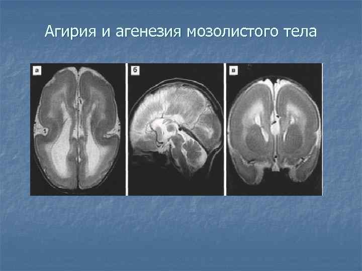 Агирия и агенезия мозолистого тела 