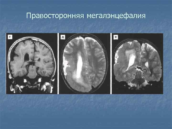 Правосторонняя мегалэнцефалия 