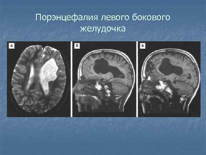 Порэнцефалия левого бокового желудочка 