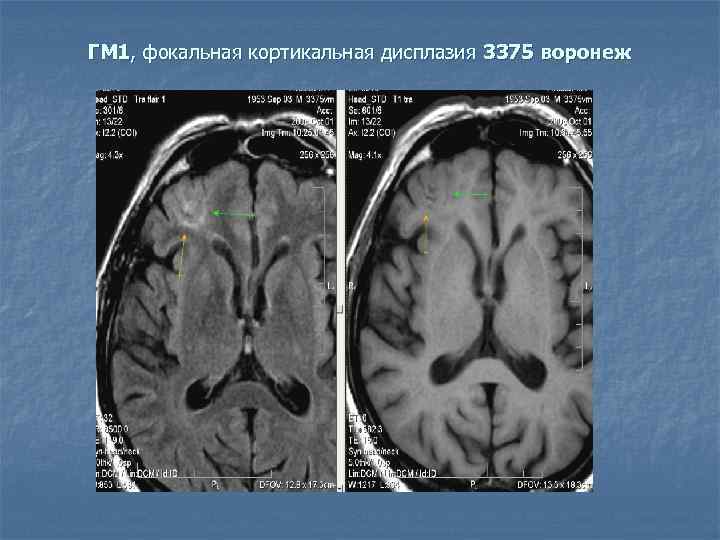 ГМ 1, фокальная кортикальная дисплазия 3375 воронеж 