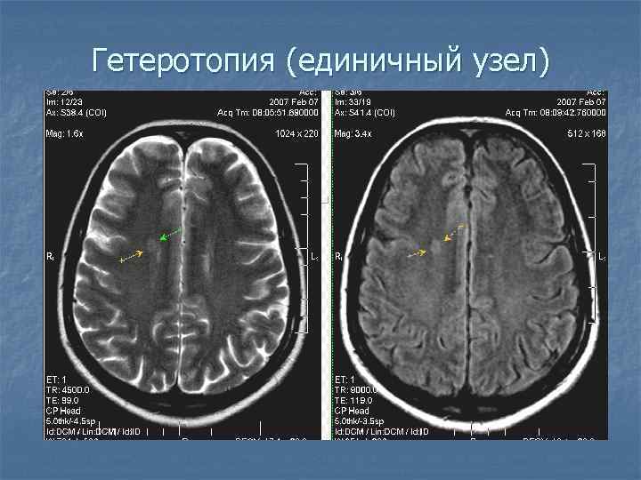 Гетеротопия (единичный узел) 