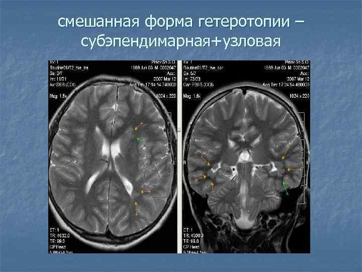 смешанная форма гетеротопии – субэпендимарная+узловая 