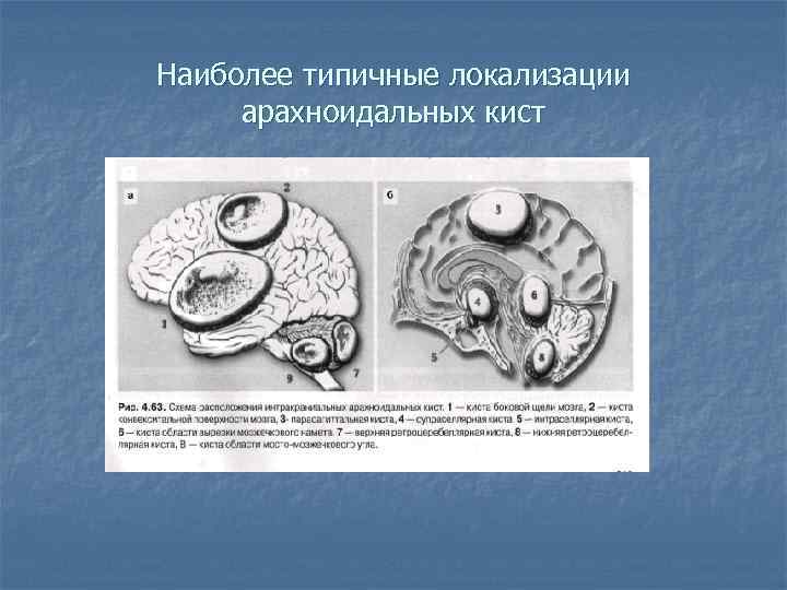 Наиболее типичные локализации арахноидальных кист 