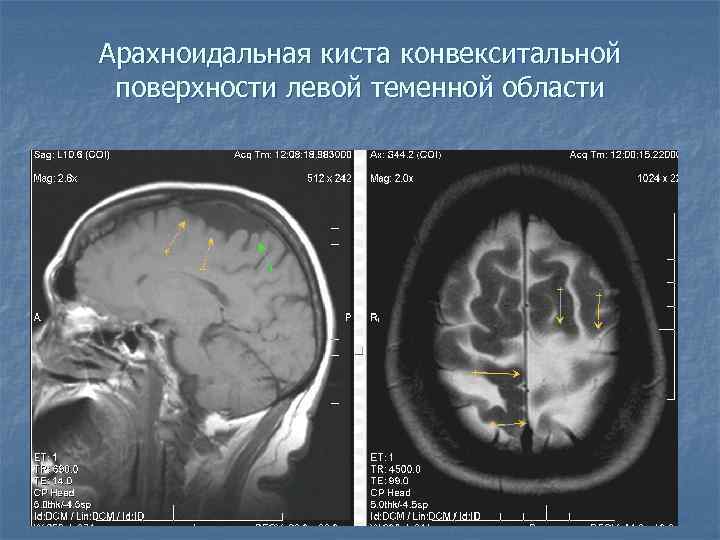 Арахноидальная киста конвекситальной поверхности левой теменной области 