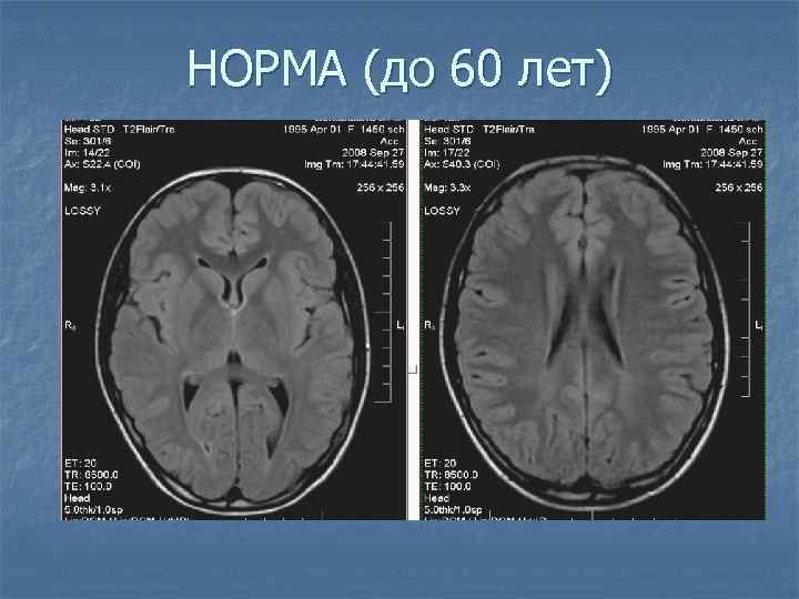 НОРМА (до 60 лет) 