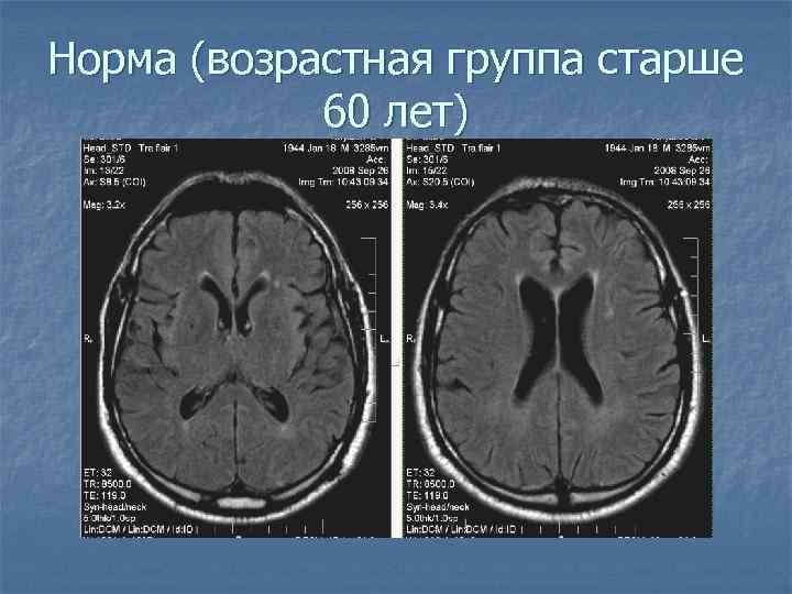 Норма (возрастная группа старше 60 лет) 