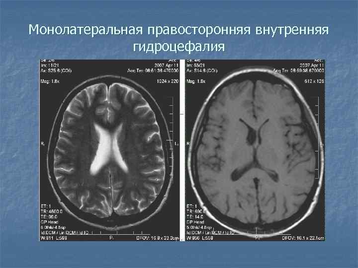 Монолатеральная правосторонняя внутренняя гидроцефалия 