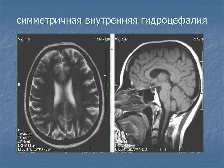 симметричная внутренняя гидроцефалия 