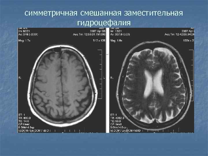 симметричная смешанная заместительная гидроцефалия 