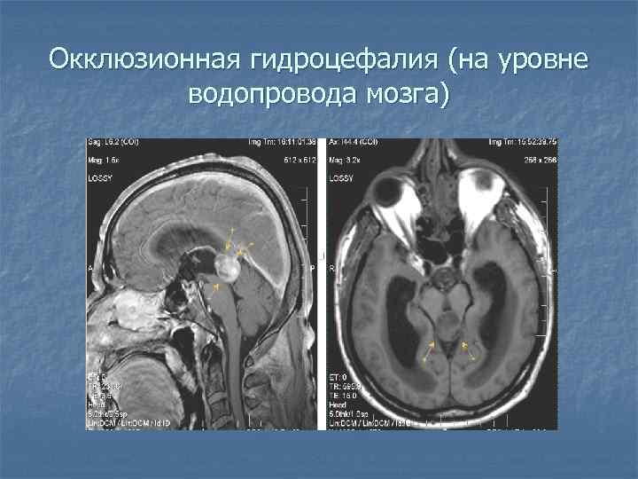 Окклюзионная гидроцефалия (на уровне водопровода мозга) 