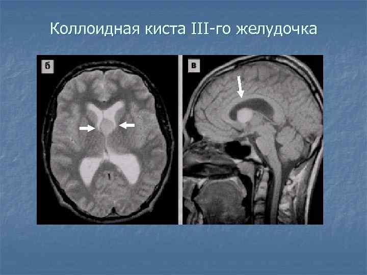 Коллоидная киста III-го желудочка 