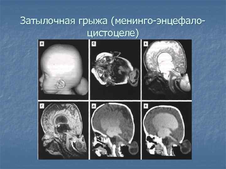 Затылочная грыжа (менинго-энцефалоцистоцеле) 