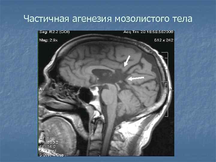 Частичная агенезия мозолистого тела 