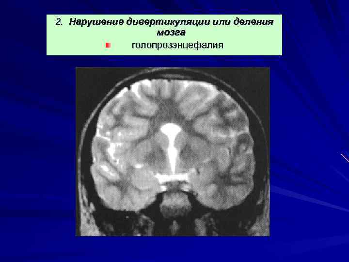 2. Нарушение дивертикуляции или деления мозга голопрозэнцефалия 