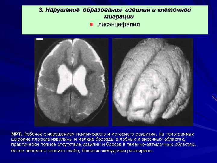3. Нарушение образования извилин и клеточной миграции лисэнцефалия МРТ. Ребенок с нарушением психического и