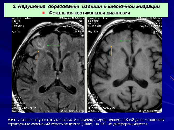 3. Нарушение образования извилин и клеточной миграции Фокальная кортикальная дисплазия МРТ. Локальный участок утолщения