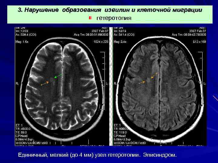 3. Нарушение образования извилин и клеточной миграции гетеротопия Единичный, мелкий (до 4 мм) узел