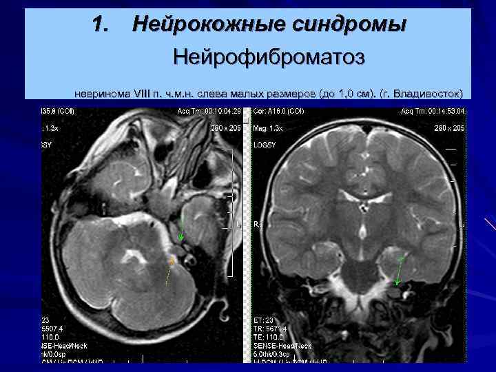 1. Нейрокожные синдромы Нейрофиброматоз невринома VIII п. ч. м. н. слева малых размеров (до