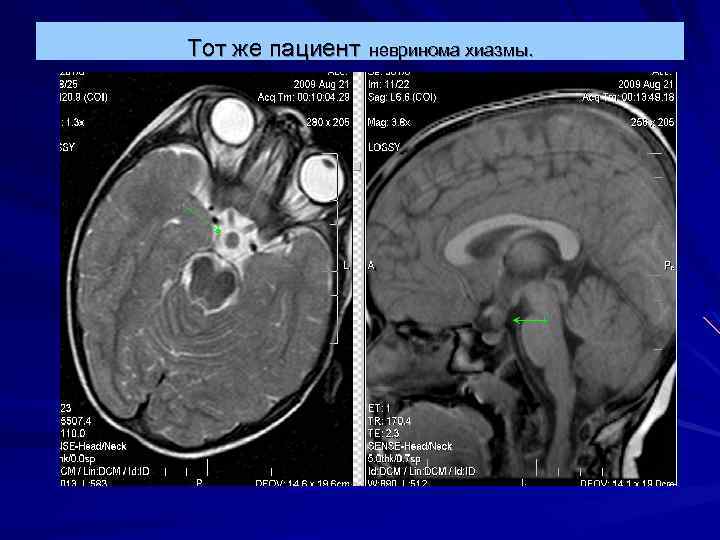 Тот же пациент невринома хиазмы. 