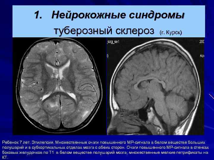 1. Нейрокожные синдромы туберозный склероз (г. Курск) Ребенок 7 лет. Эпилепсия. Множественные очаги повышенного