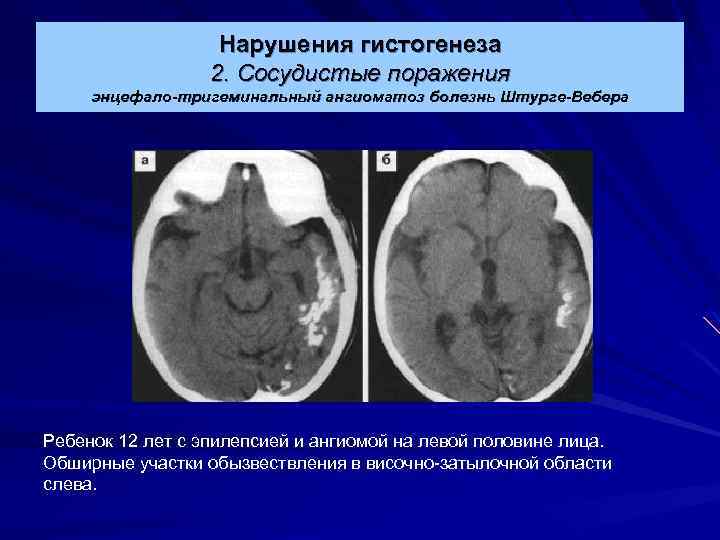 Нарушения гистогенеза 2. Сосудистые поражения энцефало-тригеминальный ангиоматоз болезнь Штурге-Вебера Ребенок 12 лет с эпилепсией