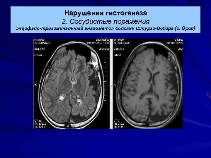 Нарушения гистогенеза 2. Сосудистые поражения энцефало-тригеминальный ангиоматоз болезнь Штурге-Вебера (г. Орел) 