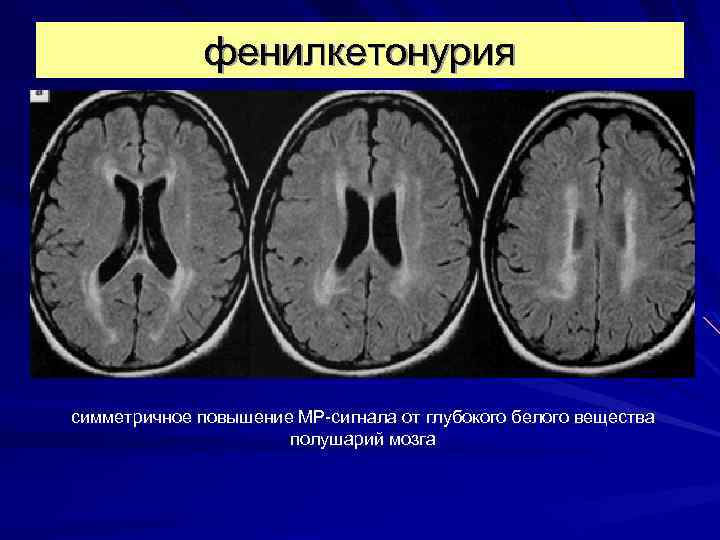 фенилкетонурия симметричное повышение МР-сигнала от глубокого белого вещества полушарий мозга 