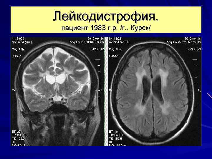 Лейкодистрофия. пациент 1983 г. р. /г. . Курск/ 