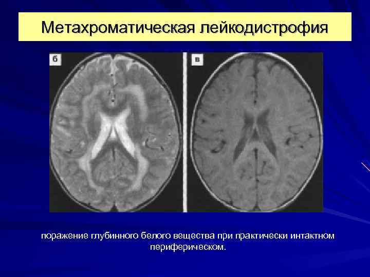 Метахроматическая лейкодистрофия поражение глубинного белого вещества при практически интактном периферическом. 