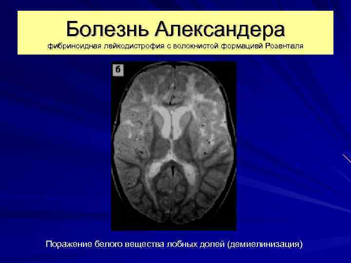 Болезнь Александера фибриноидная лейкодистрофия с волокнистой формацией Розенталя Поражение белого вещества лобных долей (демиелинизация)