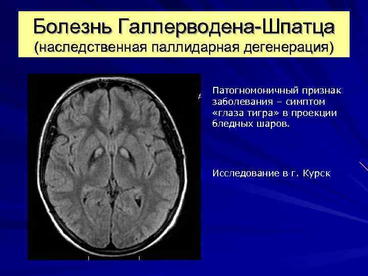 Болезнь Галлерводена-Шпатца (наследственная паллидарная дегенерация) Патогномоничный признак заболевания – симптом «глаза тигра» в проекции